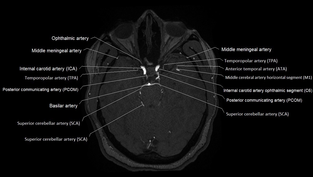 MRA brain (cerebral arteries) anatomy axial 3T image 12.webp